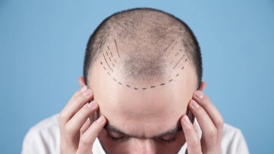 למה דווקא טורקיה? הכירו את השתלות השיער בטורקיה